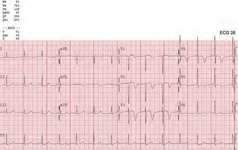 Whelens electrocardiogram result
