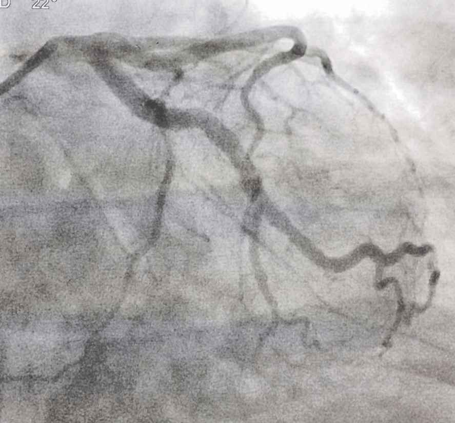 Final angiography