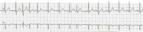 Sinus rhythm with frequent pacs