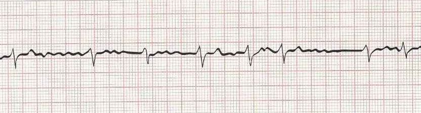 Atrial Fibrillation (irregular rhythm without discernible P waves)