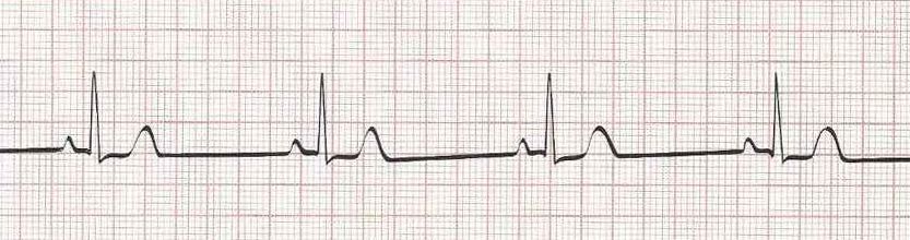 Sinus bradycardia - heart rate 40