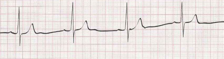 Sinus Bradycardia (heart rate less than 60)