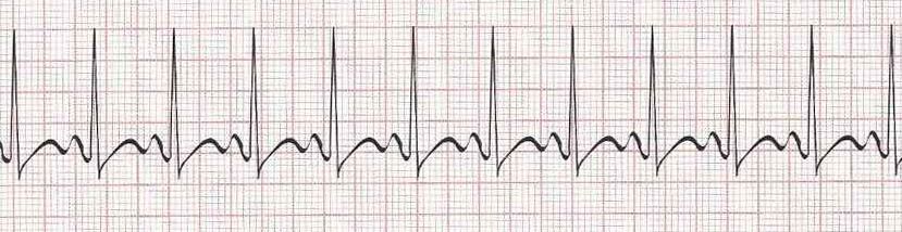 Sinus tachycardia - heart rate greater than 100