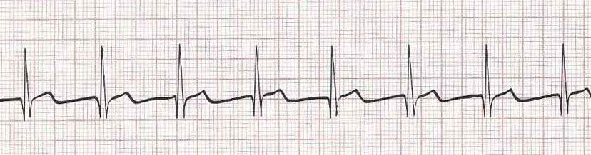 Accellerated Junctional Rhythm