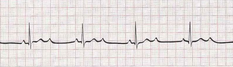 2nd Degree AV Block Mobitz II (2 or more P waves for every QRS)