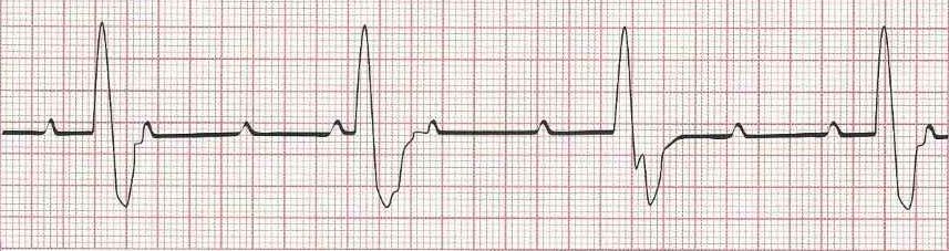 Complete heart block (3rd degree heart block) with ventricular (wide) response