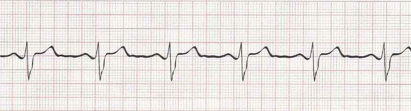 Sinus Bradycardia - 1st Degree AV Block (PR 0.22 seconds)