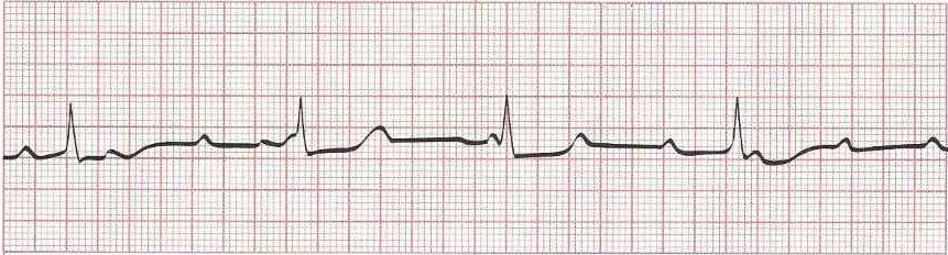 Complete heart block (3rd degree)