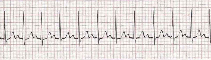 Sinus Tachycardia - heart rate greater than 100