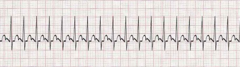 Sinus Tachycardia - Possibility of atrial flutter with 2:1 block