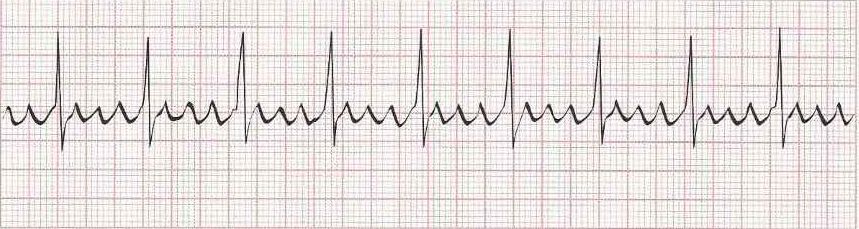 Atrial Flutter with 4:1 Block (sawtooth baseline)