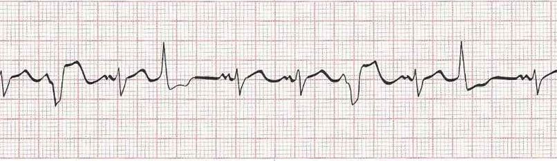 Sinus rhythm with multifocal PVCs  (PVCs look different from each other)