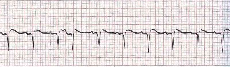 Sinus Rhythm with Premature Atrial Contractions (PACs)