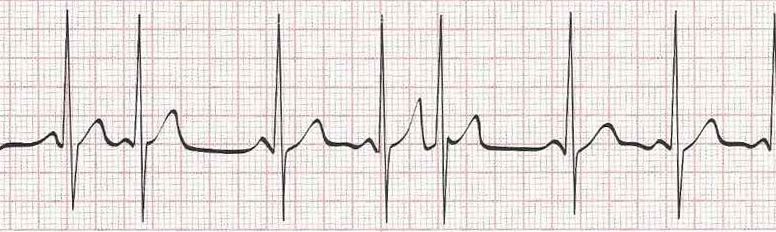 Sinus Rhythm with Frequent PACs