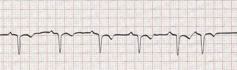Sinus Rhythm with Premature Atrial Contraction