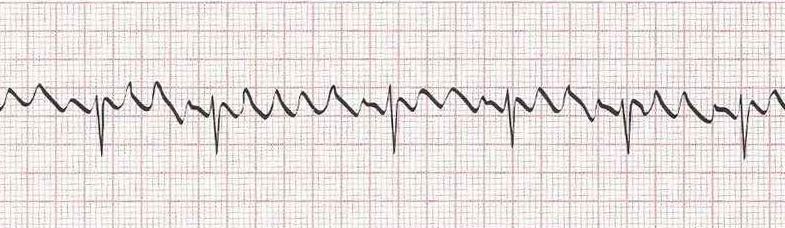 Atrial Flutter with variable block
