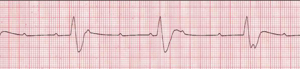Complete heart block (3rd degree) with ventricular (wide) response