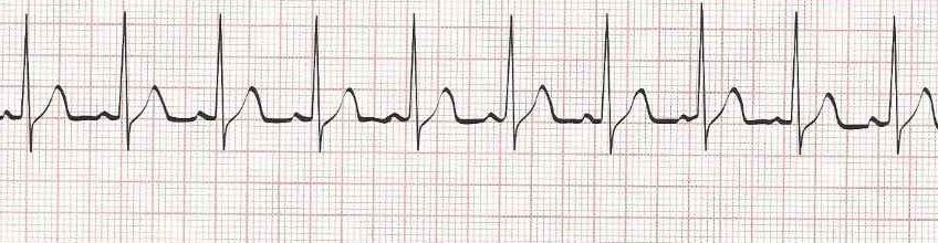 Wandering atrial pacemaker (p waves look different)