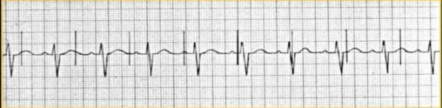Sinus Rhythm with 1st Degree AV block and a Pacer with Failure to Sense