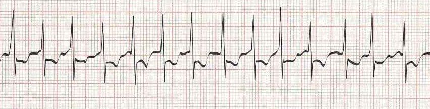 Atrial Fibrillation (rate 140):  Irregular without discernible P waves
