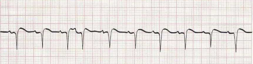 Sinus Rhythm with a PAC:  4th beat is early and narrow with compensatory pause