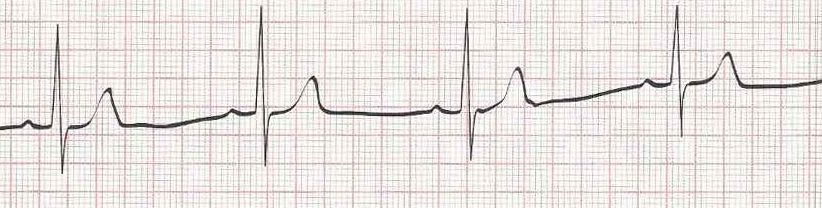 Sinus Brady - heart rate is less than 60