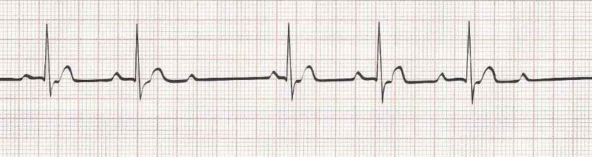 Second Degree AV Block (Second degree heart block) Type I (Wenckebach) PR longer, longer, dropped beat