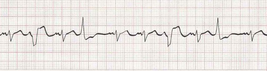 Sinus Rhythm with multifocal PVC's  (PVCs look different from each other)