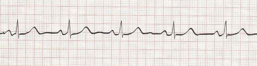 Sinus Bradycardia with 1st degree AV block  (PR 0.22 seconds) HR=50
