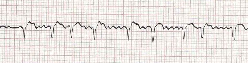 Atrial flutter with varying conduction (saw tooth baseline)