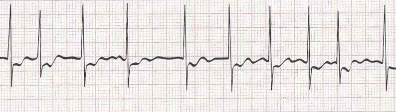 Atrial Fibrillation (irregular rhythm without discernible P waves)