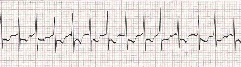 Atrial fib (would accept atrial flutter) at rate of 140
