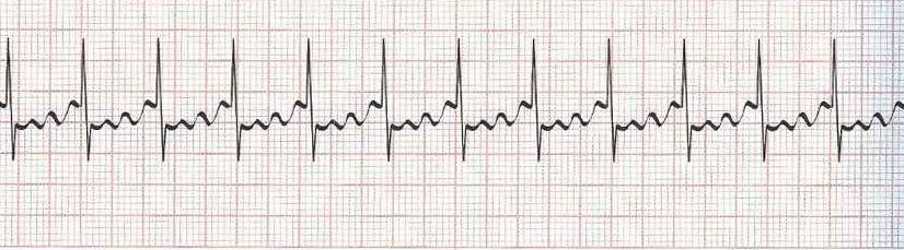 Atrial flutter with 3:1 conduction