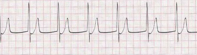Accelerated junctional rhythm (heart rate is 70)
