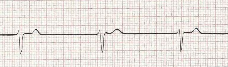 Junctional Rhythm (rate of 30)