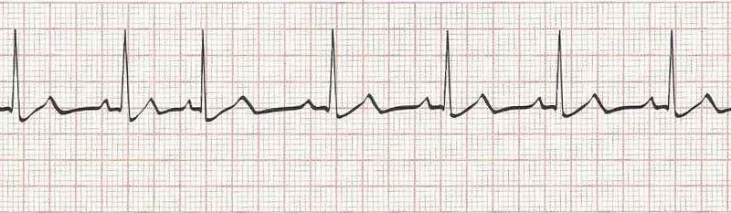 Sinus Rhythm with Premature Atrial Contraction (PAC 3rd beat)