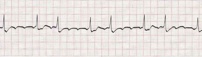 Atrial flutter (basic)  Atrial Tachycardia with block if more advanced