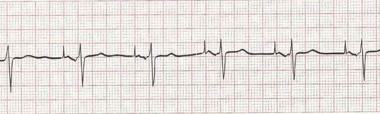 Sinus rhythm with AV sequential pacing (atrial firing and conducting)
