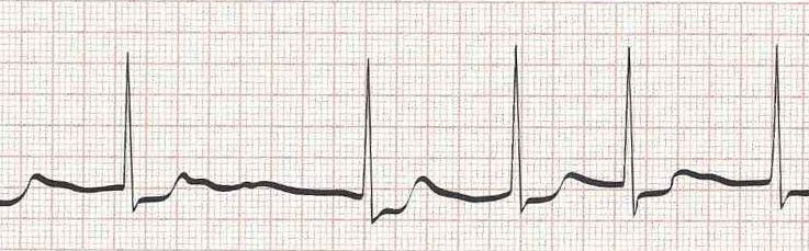 Atrial Fibrillation  (Irregular rhythm without discernible P waves)