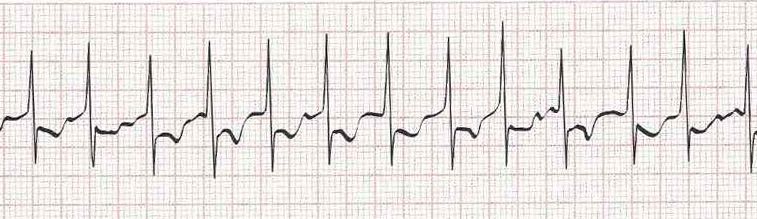 Atrial fibrillation (irregular rhythm without discernible P waves)
