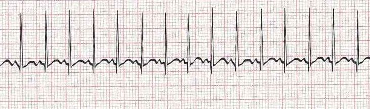 Sinus tachycardia - heart rate greater than 100