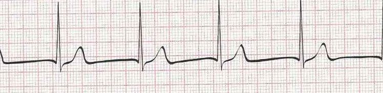 Junctional Rhythm (rate of 60)