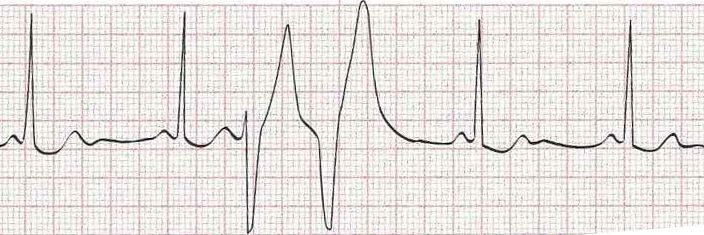 Sinus rhythm with vetricular couplet (two PVCs in a row)