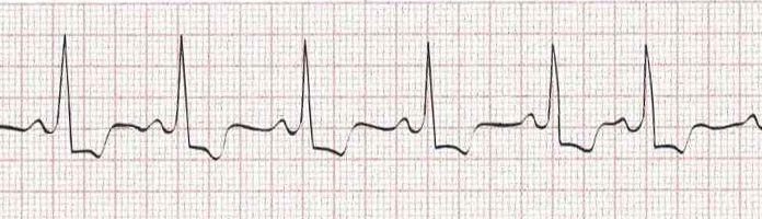 Sinus rhythm with a premature atrial contraction (PAC 7th beat)