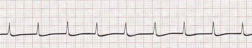 Accelerated Junctional Rhythm (regular, no P waves, rate >60)