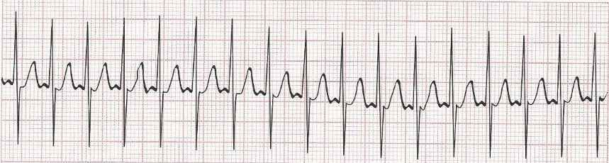 Sinus Tachycardia - heart rate greater than 100